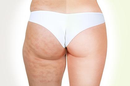 Banish Cellulite for Good with These 5 Simple and Easy Steps!