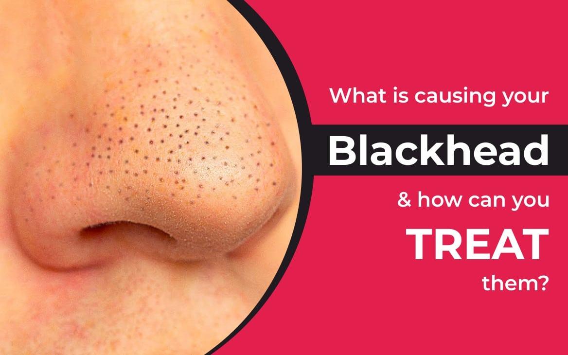 Say Goodbye to Blackheads with our Revolutionary Removal Software